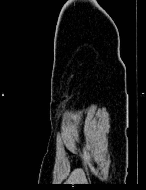 Bilateral ovarian teratoma (Radiopaedia 83131-97503 D 14).jpg