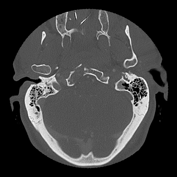 File:Bilateral perched facets with cord injury (Radiopaedia 45587-49713 Axial bone window 12).jpg