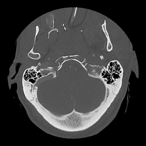 File:Bilateral perched facets with cord injury (Radiopaedia 45587-49713 Axial bone window 16).jpg