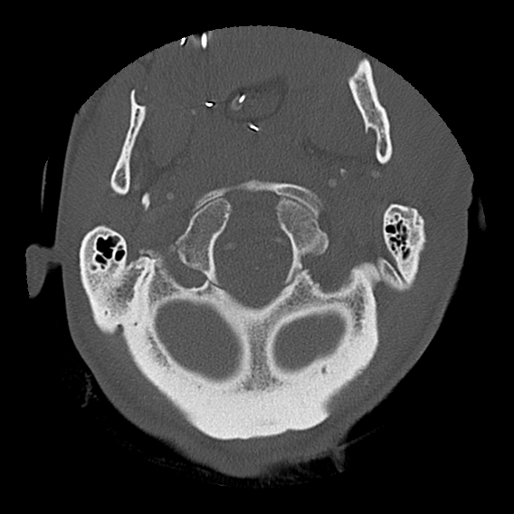 File:Bilateral perched facets with cord injury (Radiopaedia 45587-49713 Axial bone window 21).jpg