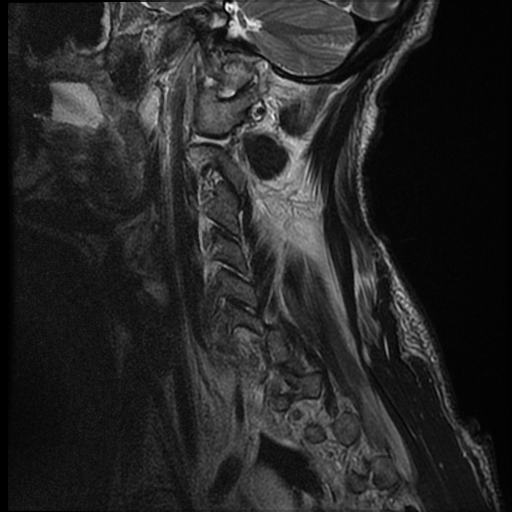 File:Bilateral perched facets with cord injury (Radiopaedia 45587-49714 Sagittal T2 16).jpg