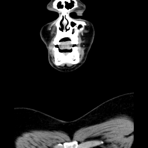 Bilateral peritonsillar abscess (Radiopaedia 85065-100610 Coronal 13).jpg