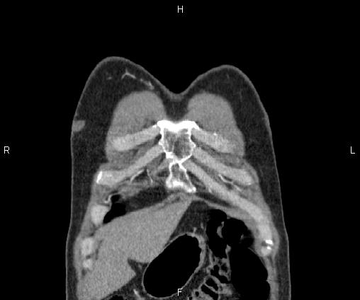Bilateral pulmonary AVM (Radiopaedia 83134-97505 C 9).jpg