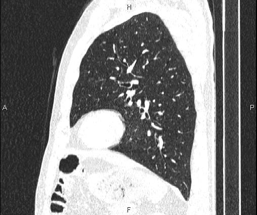 File:Bilateral pulmonary AVM (Radiopaedia 83134-97505 Sagittal lung window 80).jpg