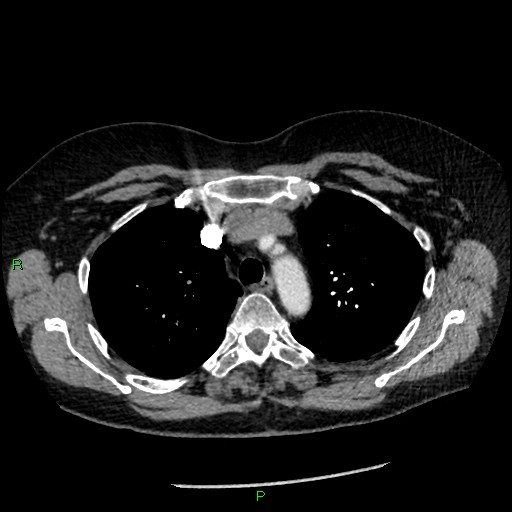 Bilateral pulmonary emboli (Radiopaedia 32700-33669 Axial C+ CTPA 30).jpg