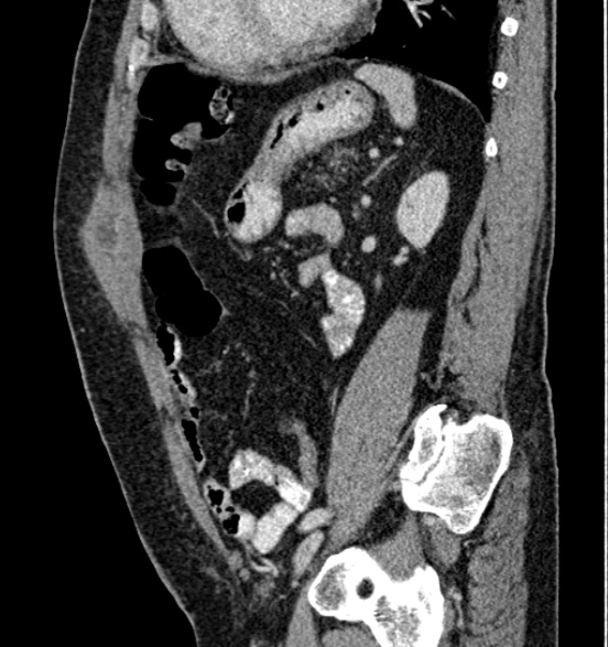 Bilateral rectus sheath hematomas (Radiopaedia 50778-56252 B 54).jpg