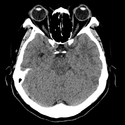 File:Bilateral subacute subdural hematoma (Radiopaedia 69240-79018 Axial non-contrast 16).jpg
