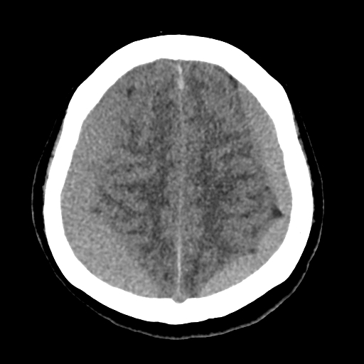 Bilateral subacute subdural hematoma (Radiopaedia 69240-79018 Axial non-contrast 38).jpg