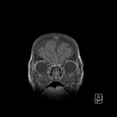 Bilateral subdural hemorrhage and parietal skull fracture (Radiopaedia 26058-26190 Coronal T1 6).png