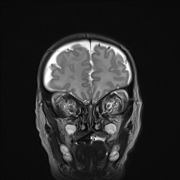 File:Bilateral subdural hemorrhage and parietal skull fracture (Radiopaedia 26058-26190 Coronal T2 4).png