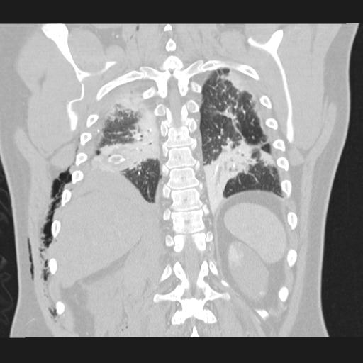 Bilateral traumatic renovascular injury (Radiopaedia 32051-32995 Coronal lung window 62).jpg
