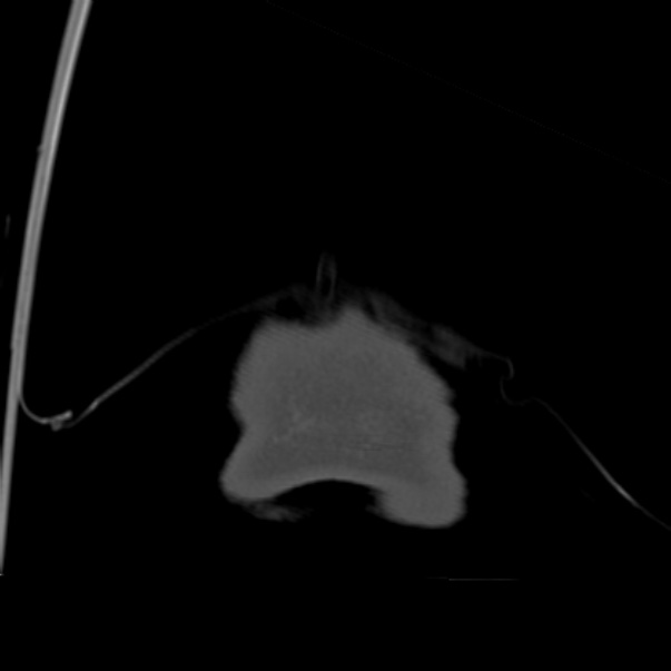 Biparietal osteodystrophy (Radiopaedia 46109-50463 Coronal bone window 109).jpg