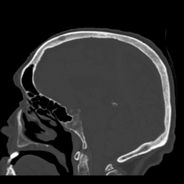 Biparietal osteodystrophy (Radiopaedia 46109-50463 Sagittal bone window 51).jpg