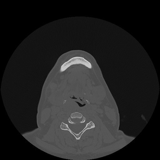 File:Bisphosphonate-related osteonecrosis of the jaw (Radiopaedia 71324-81642 Axial bone window 17).jpg