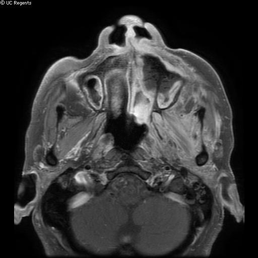 Bisphosphonate-related osteonecrosis of the maxilla (Radiopaedia 51367-57101 Axial T1 C+ fat sat 23).jpg