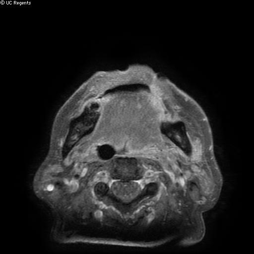 Bisphosphonate-related osteonecrosis of the maxilla (Radiopaedia 51367-57101 Axial T1 C+ fat sat 7).jpg