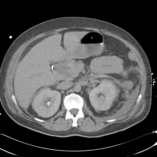 File:Bladder rupture post renal biopsy (Radiopaedia 30863-31572 Axial non-contrast 33).jpg