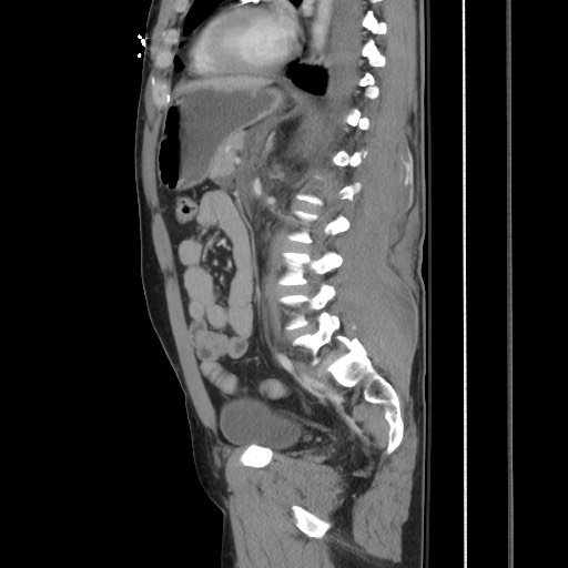 Blunt abdominal trauma with solid organ and musculoskelatal injury with active extravasation (Radiopaedia 68364-77895 C 88).jpg