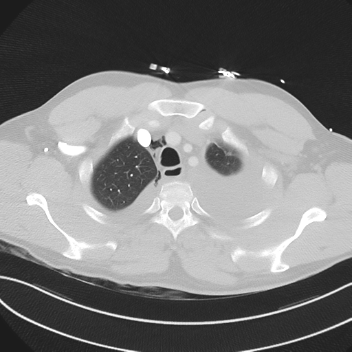 File:Boerhaave syndrome (Radiopaedia 39382-41660 Axial lung window 10).png