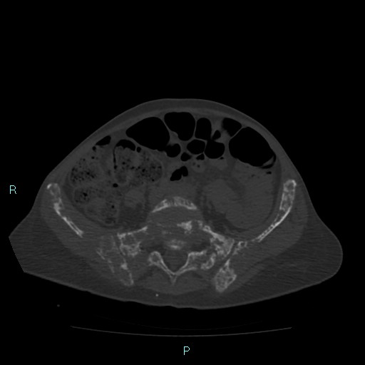 File:Bone metastases from untreated breast cancer (Radiopaedia 42973-46219 Axial bone window 145).jpg