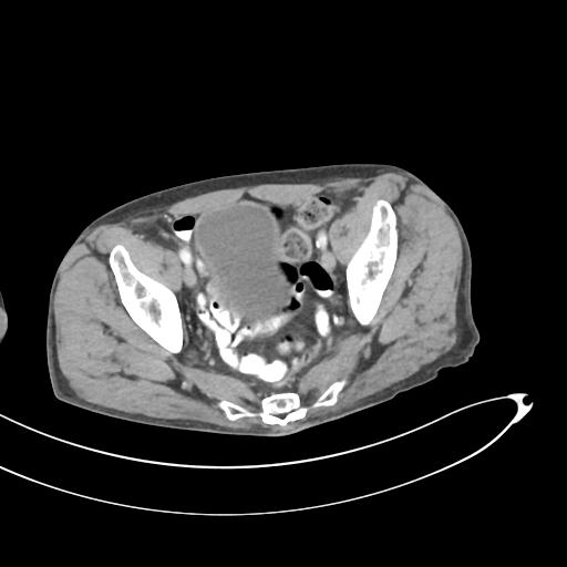 Bone metastasis from squamous cell carcinoma (Radiopaedia 30133-30730 B 65).jpg