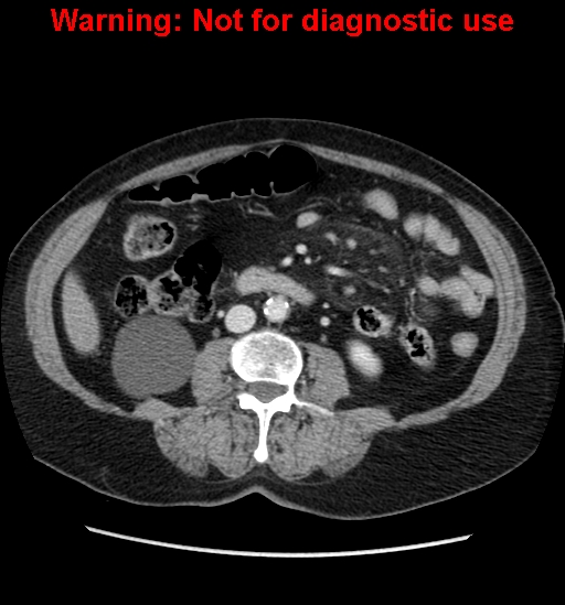 File:Bosniak renal cyst - type II (Radiopaedia 23404-23468 D 36).jpg