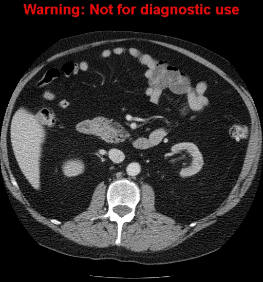 File:Bosniak renal cyst - type IV (Radiopaedia 23402-23466 D 30).jpg