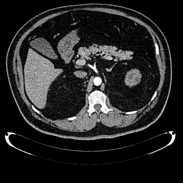 File:Bosniak renal cyst - type IV (Radiopaedia 24244-24518 B 106).jpg