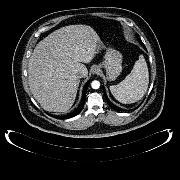 File:Bosniak renal cyst - type IV (Radiopaedia 24244-24518 B 52).jpg