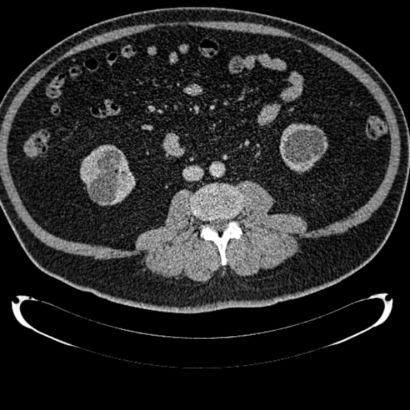 Bosniak renal cyst - type IV (Radiopaedia 24244-24518 C 205).jpg