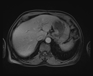 File:Bouveret syndrome (Radiopaedia 61017-68856 Axial T1 C+ fat sat 17).jpg