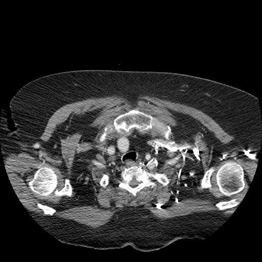 Bovine aortic arch - right internal mammary vein drains into the superior vena cava (Radiopaedia 63296-71875 A 14).jpg