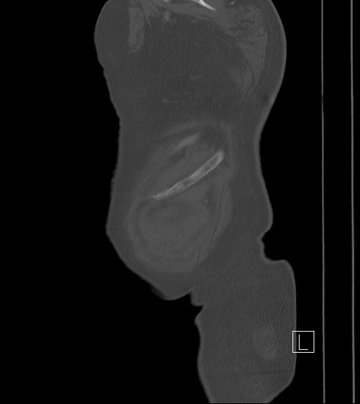 Bowel ischemia secondary to SMA occlusion with extensive portomesenteric venous gas (Radiopaedia 54656-60871 Sagittal bone window 1).jpg