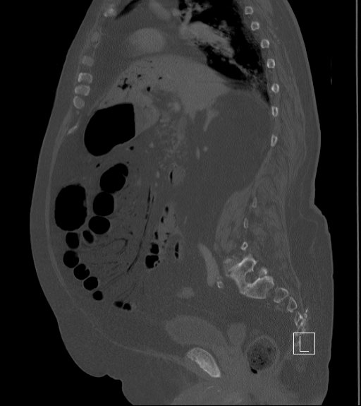 Bowel ischemia secondary to SMA occlusion with extensive portomesenteric venous gas (Radiopaedia 54656-60871 Sagittal bone window 64).jpg