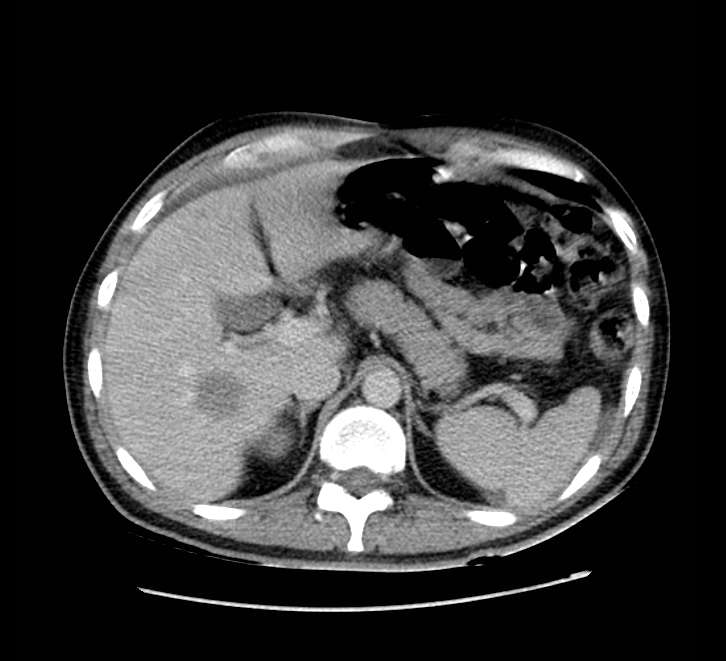 Bowel obstruction from colon carcinoma (Radiopaedia 22995-23028 A 19).jpg