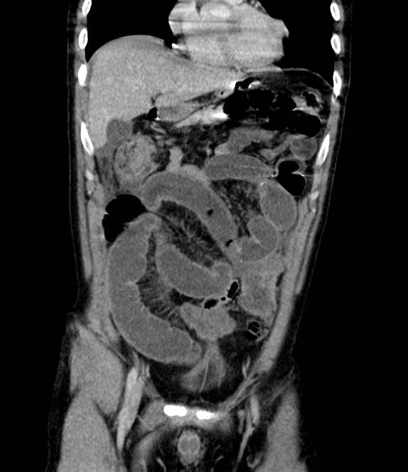 Bowel obstruction from colon carcinoma (Radiopaedia 22995-23028 C 21).jpg