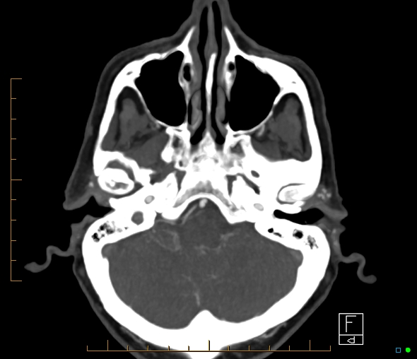 File:Brachiocephalic trunk stenosis (Radiopaedia 87242-103519 A 56).jpg