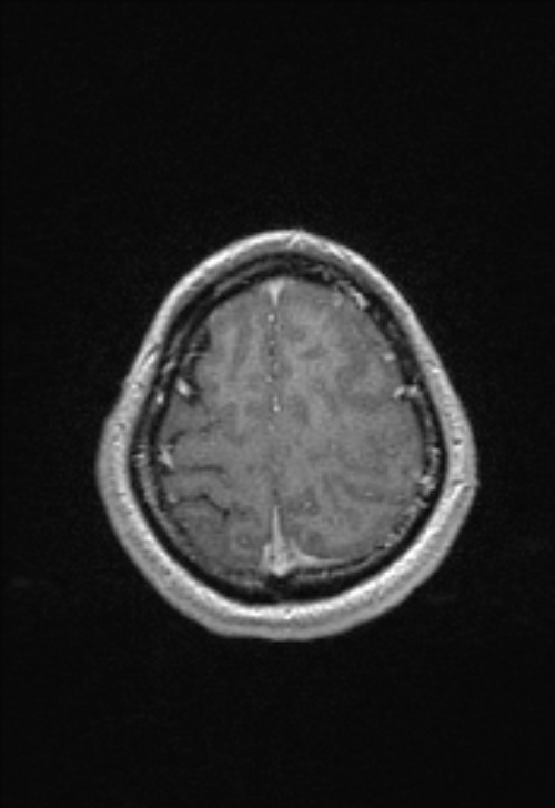 Brain abscess with ventriculitis (Radiopaedia 85703-101495 Axial T1 C+ 146).jpg
