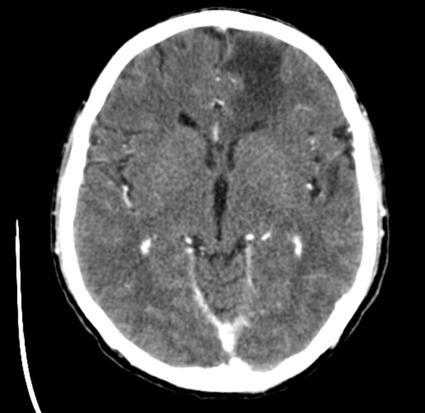 File:Brain metastases from lung cancer (Radiopaedia 24480-24781 Axial C+ delayed 27).jpg