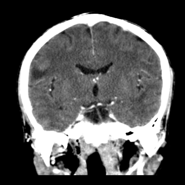 Brain metastases from lung cancer (Radiopaedia 24480-24781 Coronal C+ delayed 32).jpg
