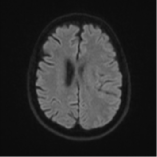 Brain metastasis (large cystic mass) (Radiopaedia 47497-52107 Axial DWI 46).png