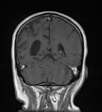 File:Brain metastasis (lung cancer) (Radiopaedia 48289-53179 Coronal T1 C+ 8).png