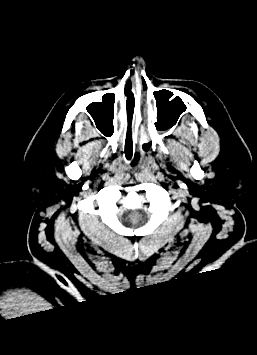 Brainstem hemorrhage (Radiopaedia 81294-94976 Axial non-contrast 61).jpg