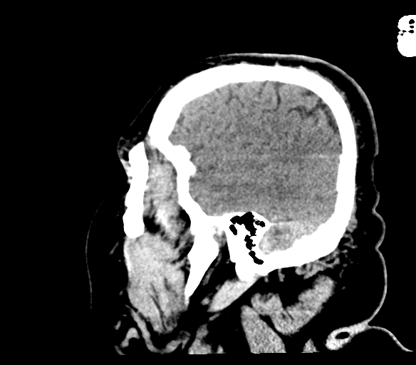 Brainstem hemorrhage (Radiopaedia 81294-94976 C 49).jpg