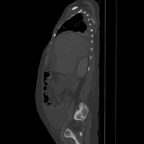 Breast cancer metastases - hepatic and skeletal (Radiopaedia 34201-35461 Sagittal bone window 31).jpg