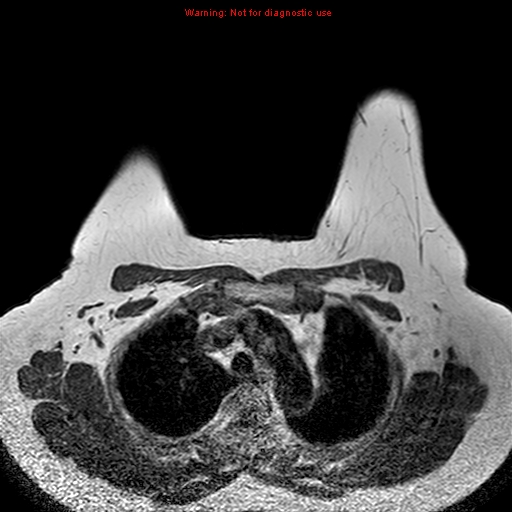 File:Breast carcinoma (multicentric multifocal in mammary Paget disease) (Radiopaedia 50966-56512 Axial T1 14).jpg