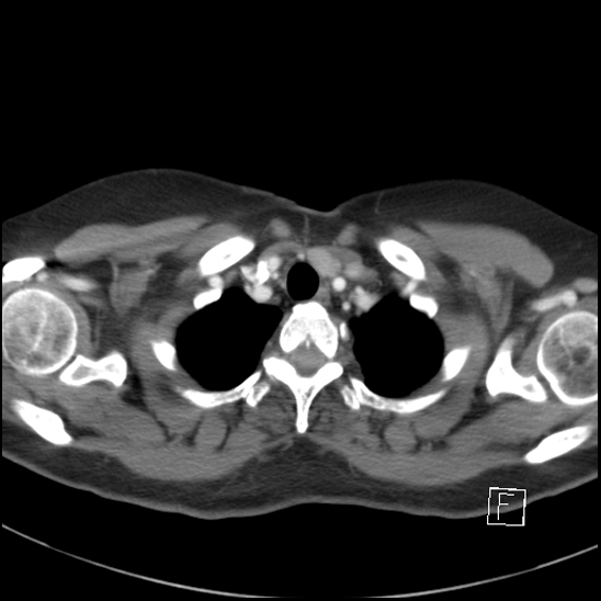 File:Breast metastases from renal cell cancer (Radiopaedia 79220-92225 A 11).jpg