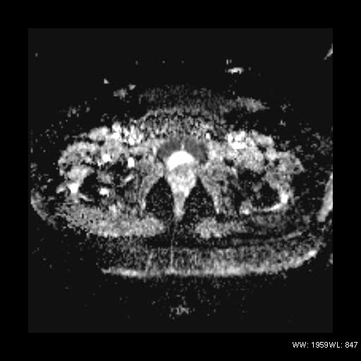 File:Broad ligament fibroid (Radiopaedia 49135-54241 Axial ADC 25).jpg