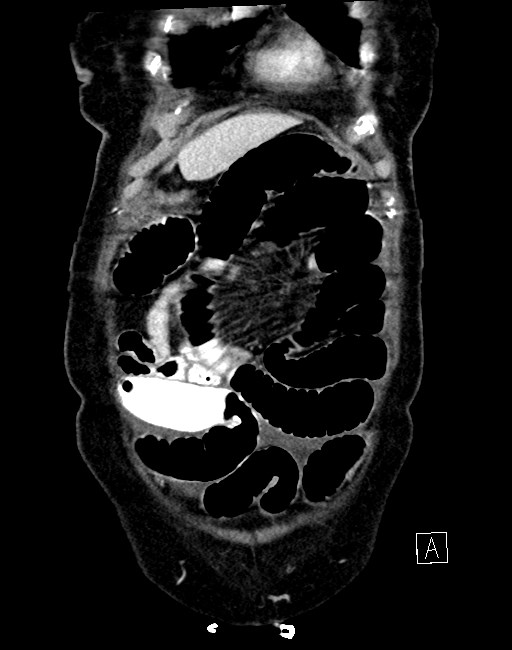 Broad ligament hernia (Radiopaedia 84802-100276 B 63).jpg
