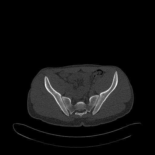 Brodie abscess- femoral neck (Radiopaedia 53862-59966 Axial bone window 67).jpg